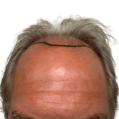 Dr Shintre Hair Restoration Boca Raton gallery photo