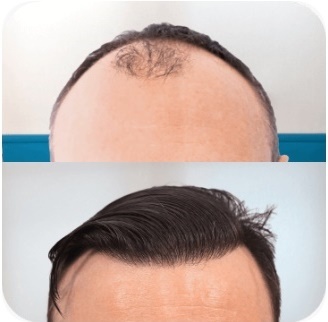 FullFace Hair Transplant Warsaw gallery photo