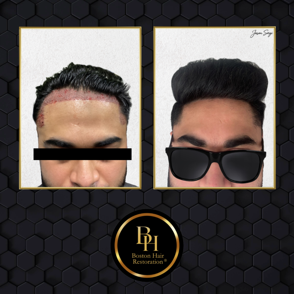 Boston Hair Restoration ® gallery photo