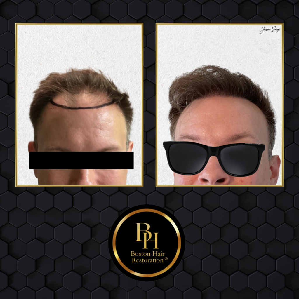 Boston Hair Restoration ® gallery photo