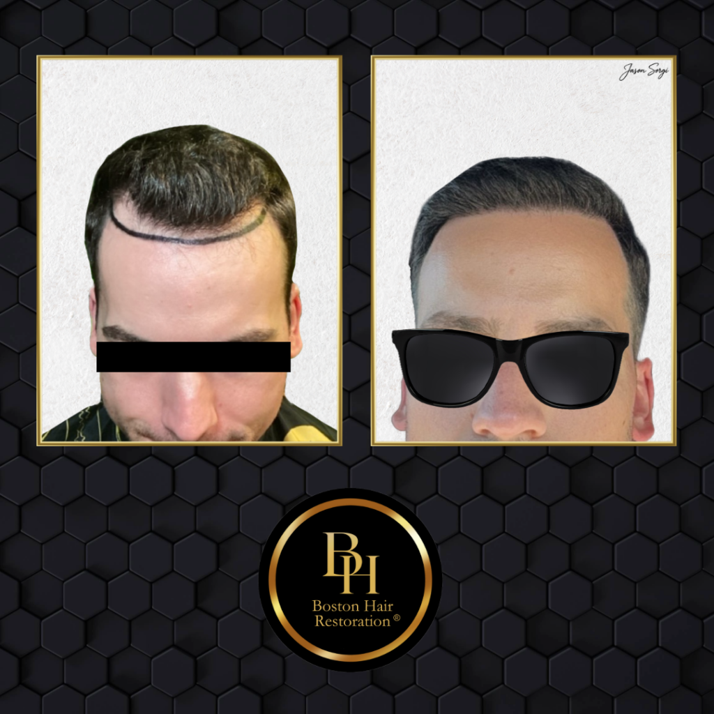 Boston Hair Restoration ® gallery photo