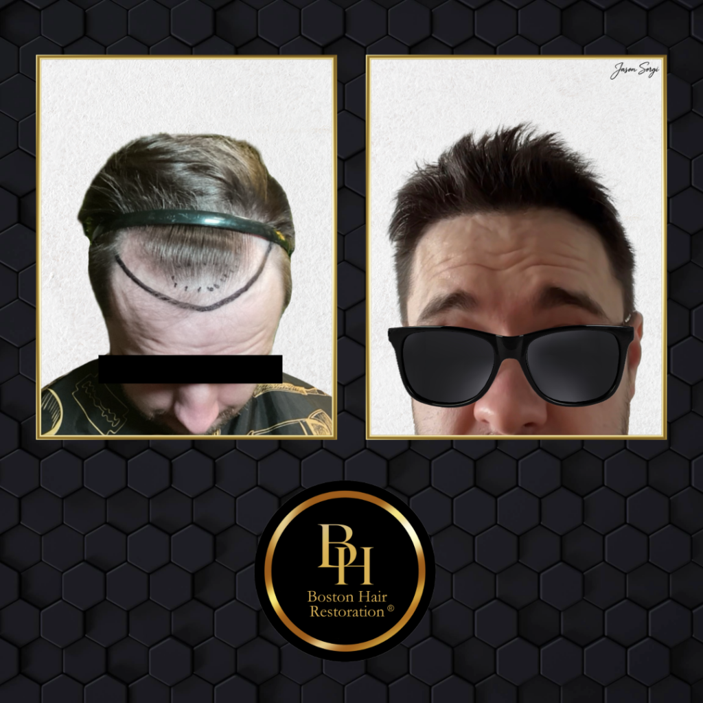 Boston Hair Restoration ® gallery photo