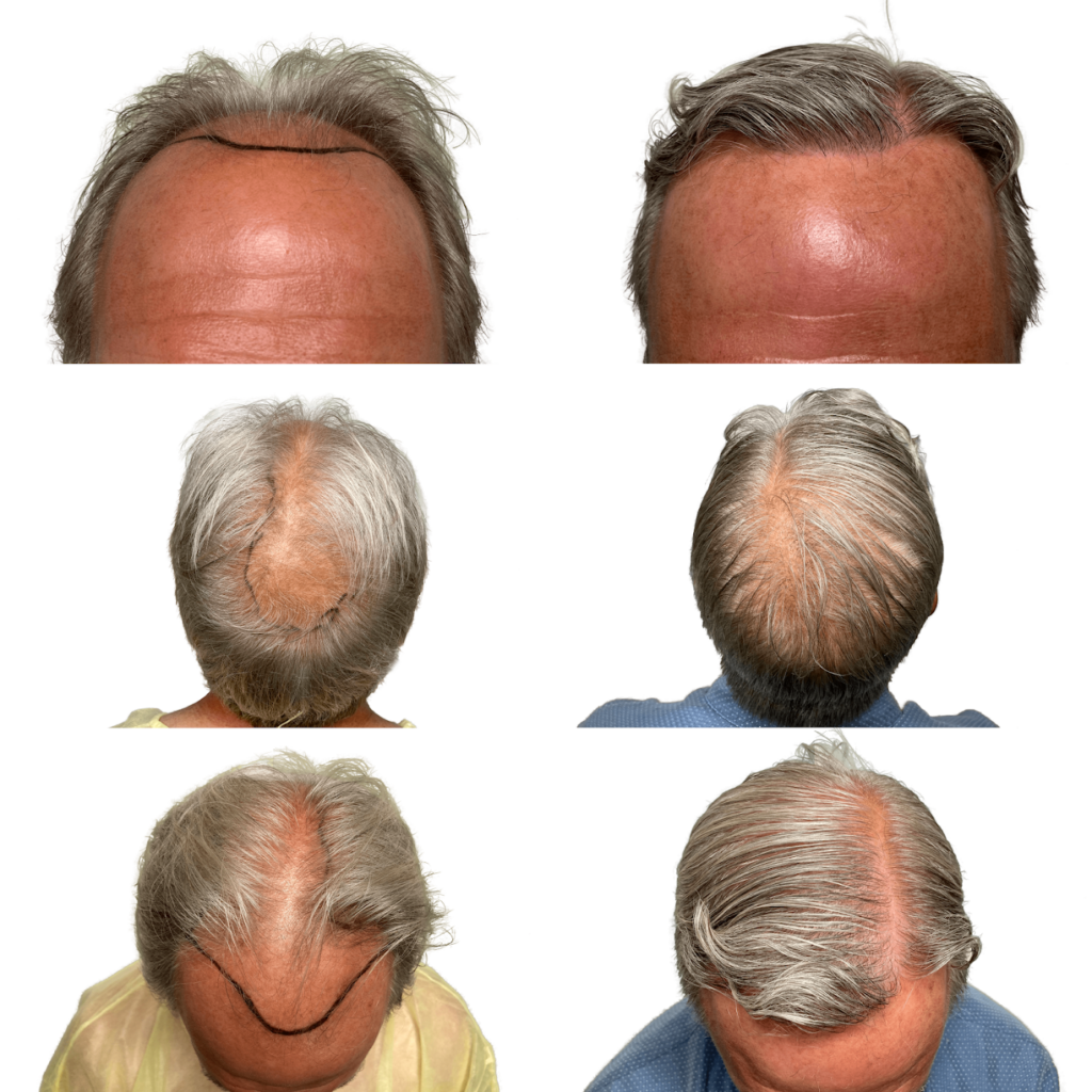 Maxim Hair Restoration & Transplants – Charlotte gallery photo