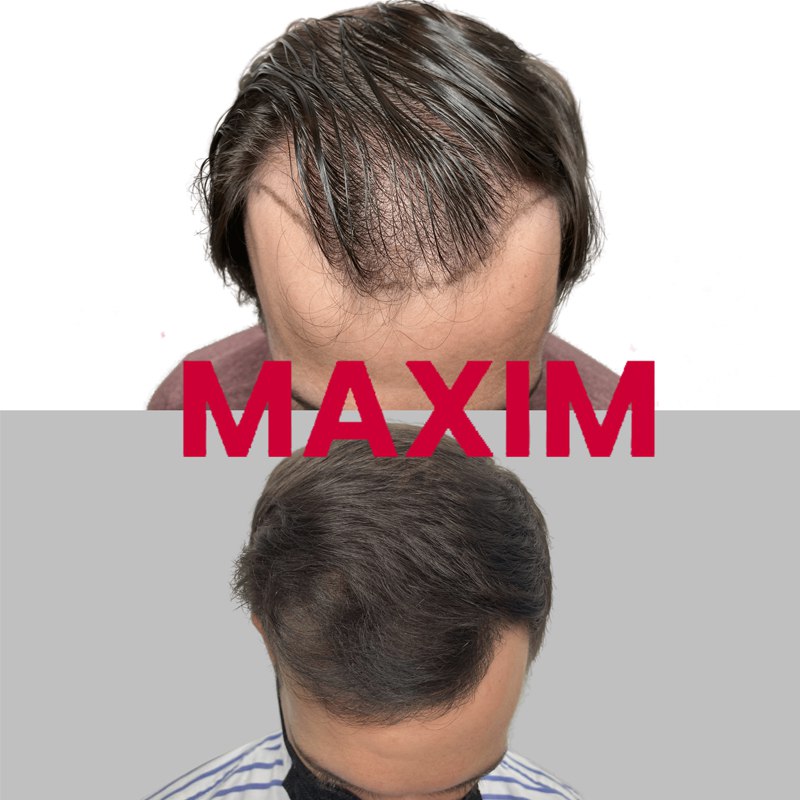 Maxim Hair Restoration & Transplants – Charlotte gallery photo