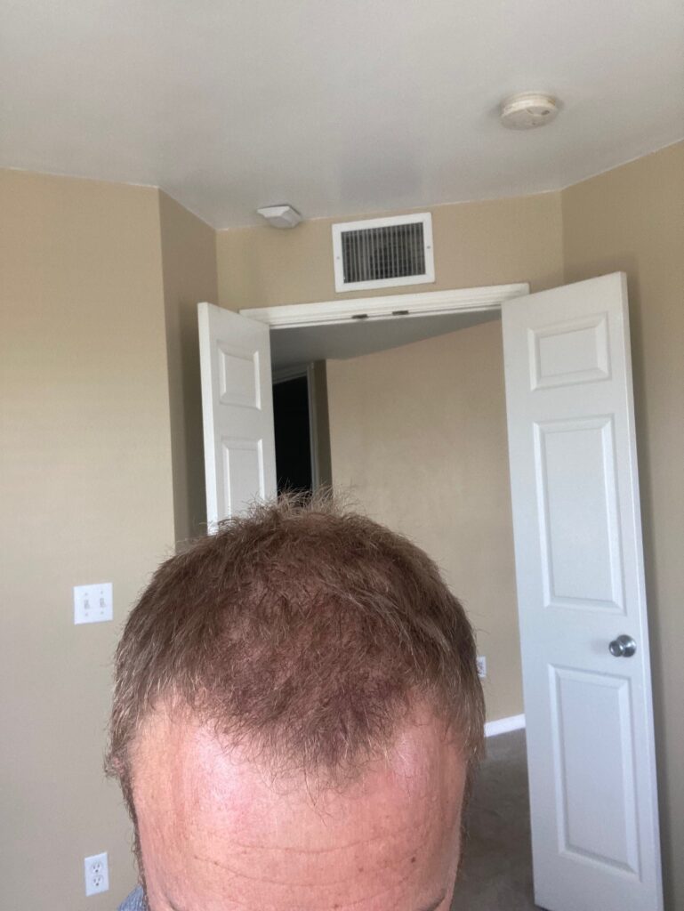 Advanced Hair Restoration gallery photo