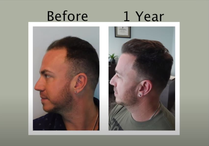 Natural Transplants, Hair Restoration Clinic gallery photo