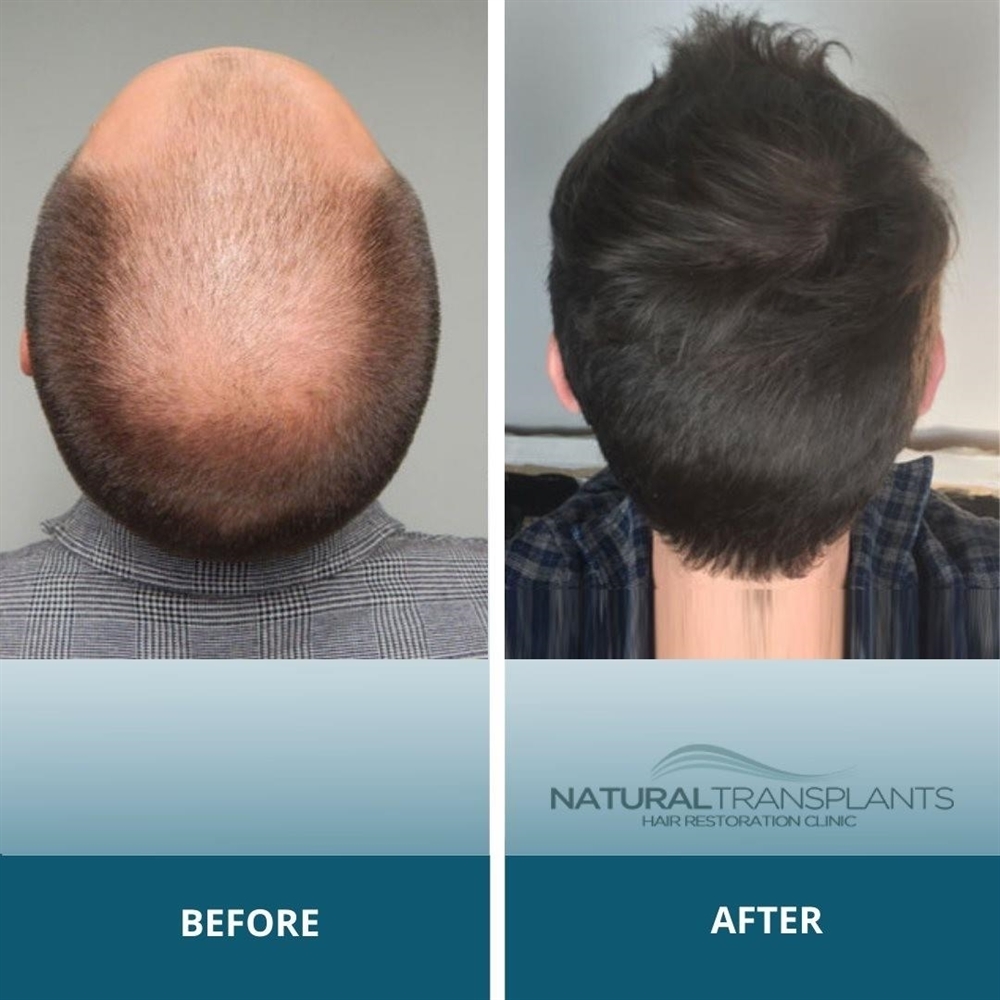 Natural Transplants, Hair Restoration Clinic gallery photo
