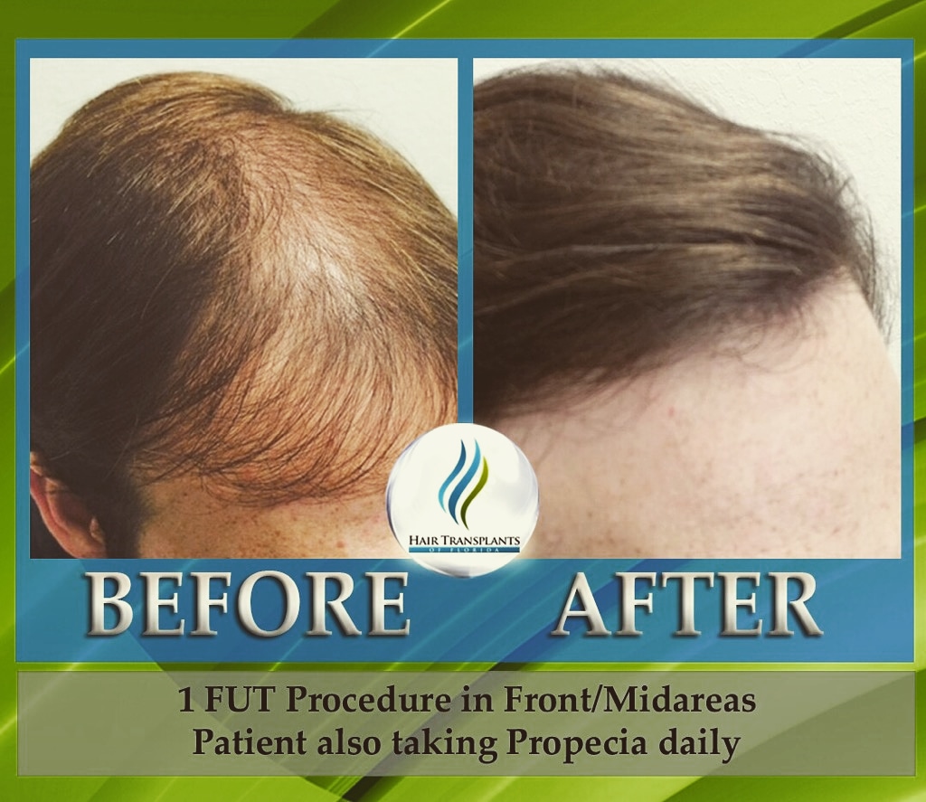 Hair Transplants of Florida gallery photo