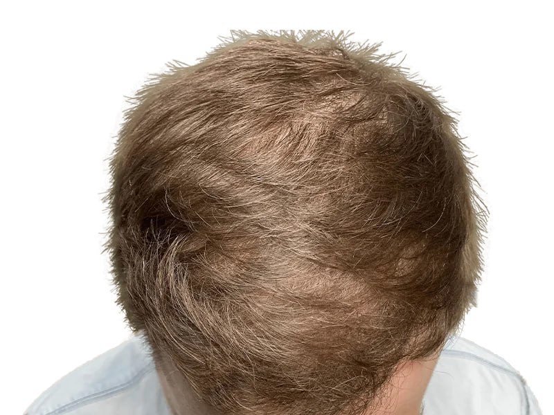 Maxim Hair Restoration & Transplants – Phoenix gallery photo