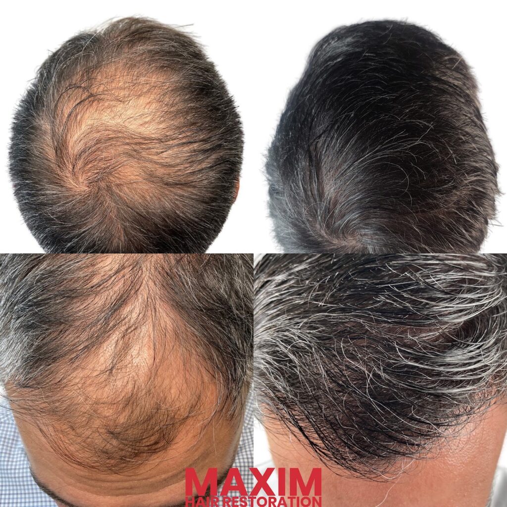Maxim Hair Restoration & Transplants – Phoenix gallery photo