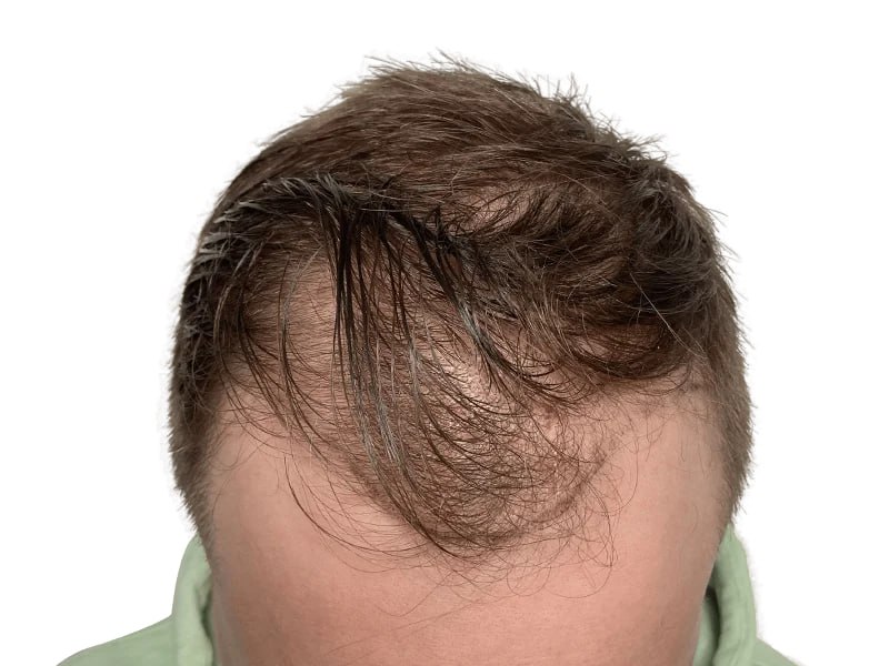 Maxim Hair Restoration & Transplants – Phoenix gallery photo