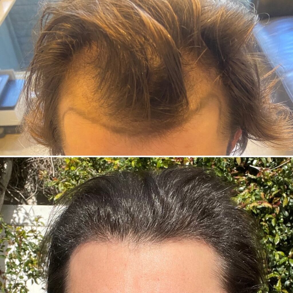 SD HAIR MD Hair Transplants gallery photo