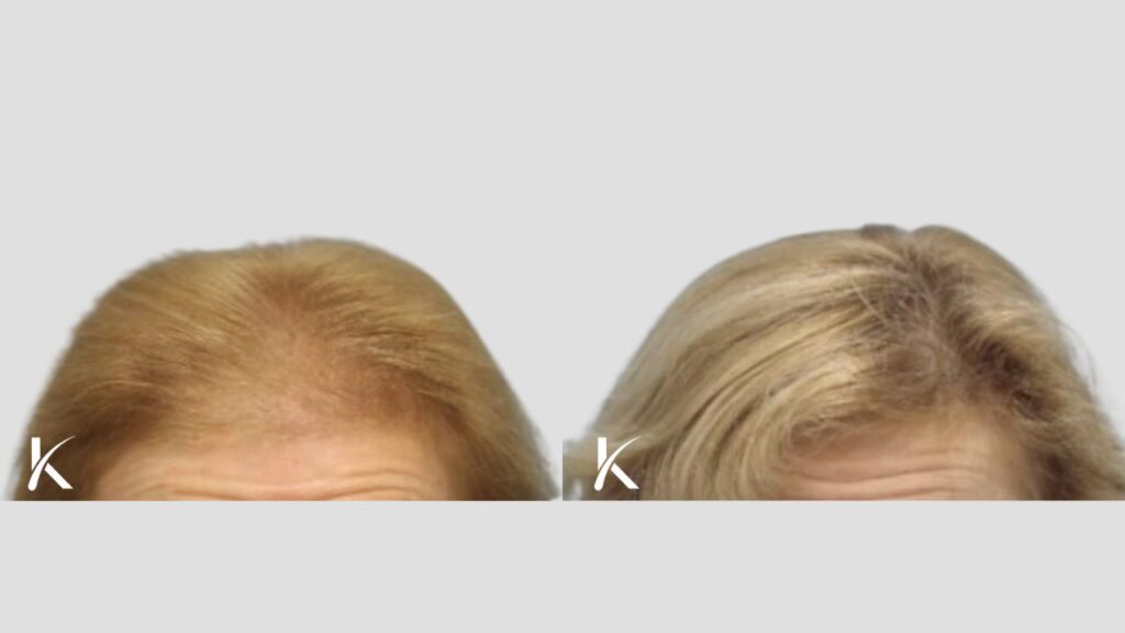 Kopelman Hair Restoration Florida | Hair Transplant Clinic gallery photo