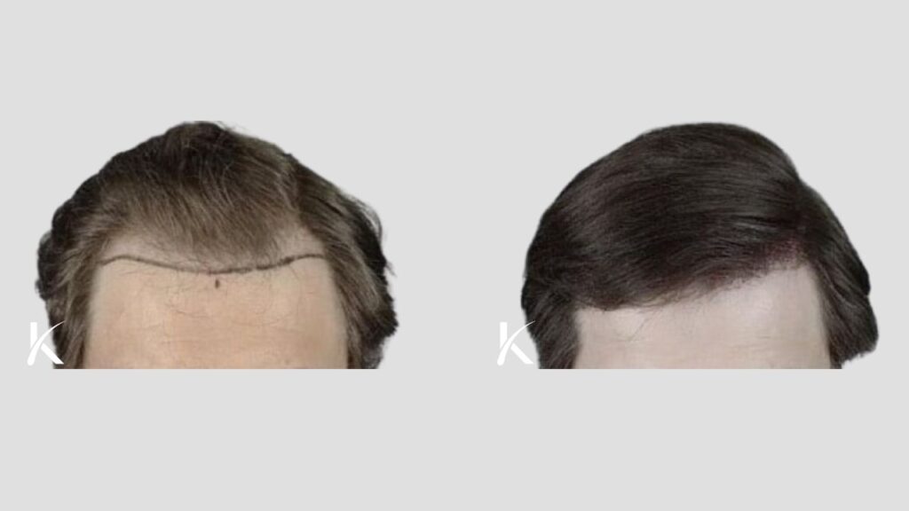 Kopelman Hair Restoration Florida | Hair Transplant Clinic gallery photo