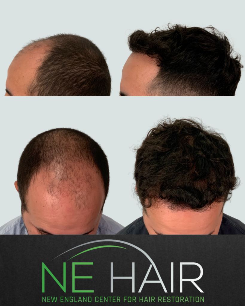 New England Center for Hair Restoration gallery photo