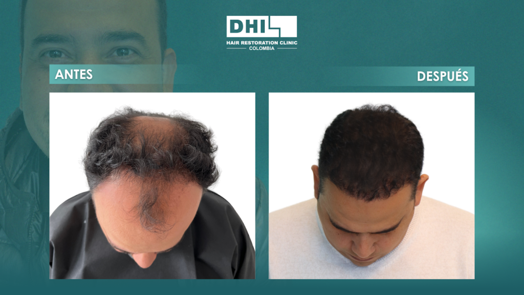 DHI COLOMBIA BARRANQUILLA ( Clínica de implante capilar) gallery photo