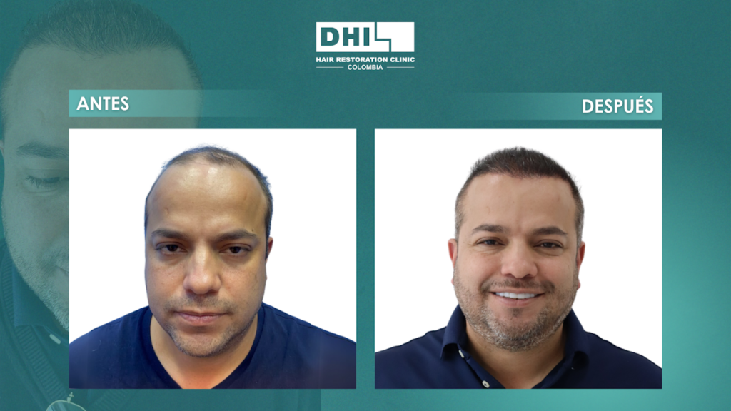 DHI COLOMBIA BARRANQUILLA ( Clínica de implante capilar) gallery photo