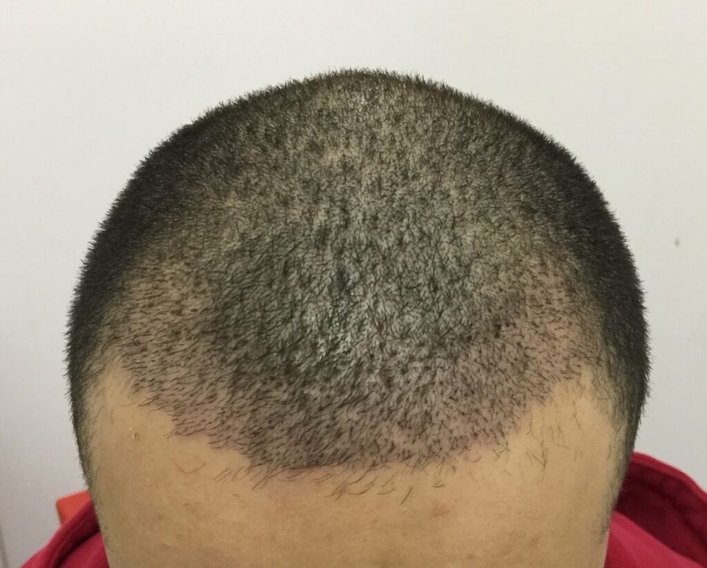 Hair Transplant Mexico, Dr. Antonio Aguilar gallery photo