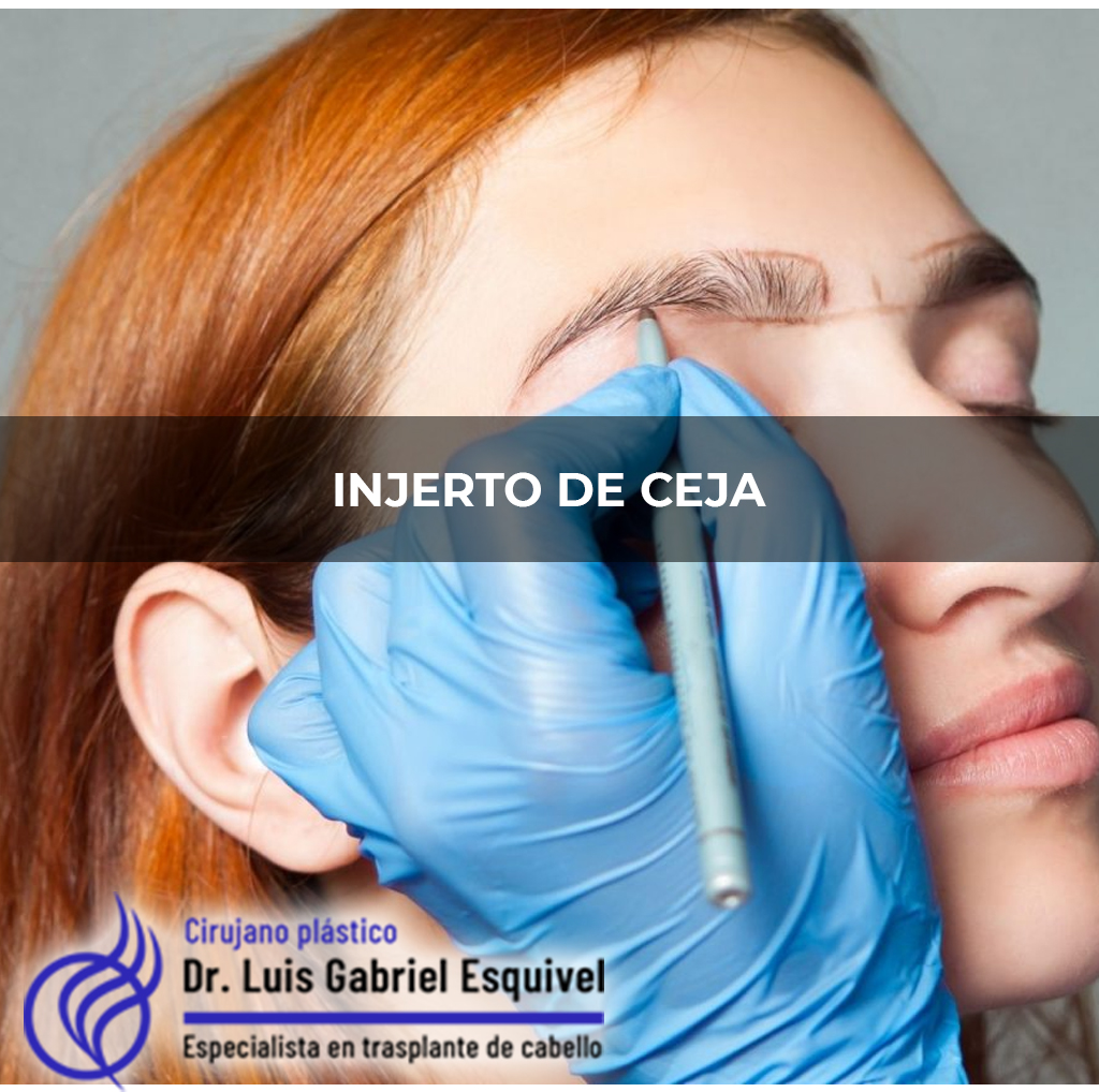 Trasplante de Cabello en Naucalpan – Dr. Luis Gabriel Esquivel gallery photo