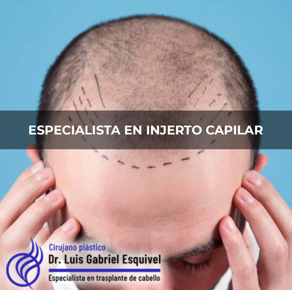 Trasplante de Cabello en Naucalpan – Dr. Luis Gabriel Esquivel gallery photo