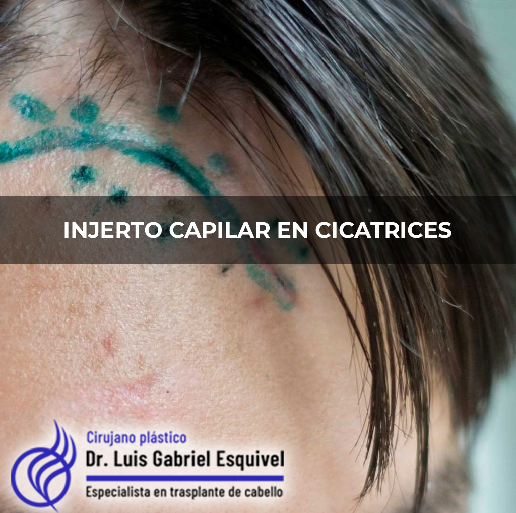 Trasplante de Cabello en Naucalpan – Dr. Luis Gabriel Esquivel gallery photo