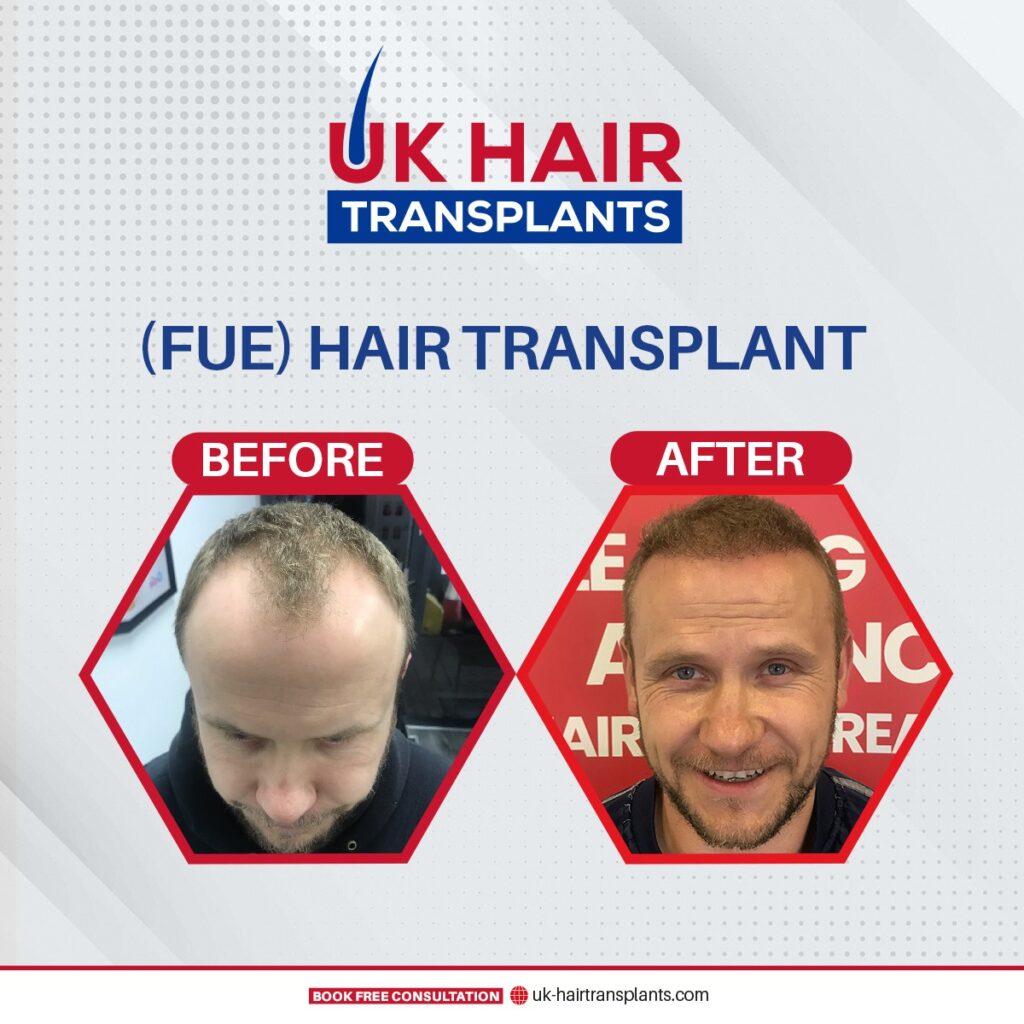 UK Hair Transplants UKHT Birmingham gallery photo