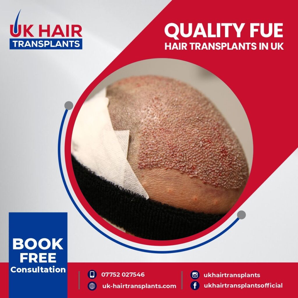 UK Hair Transplants UKHT Birmingham gallery photo