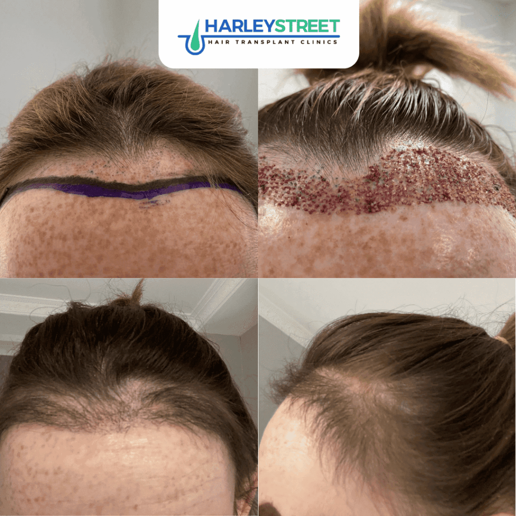 Hair Transplant Glasgow gallery photo