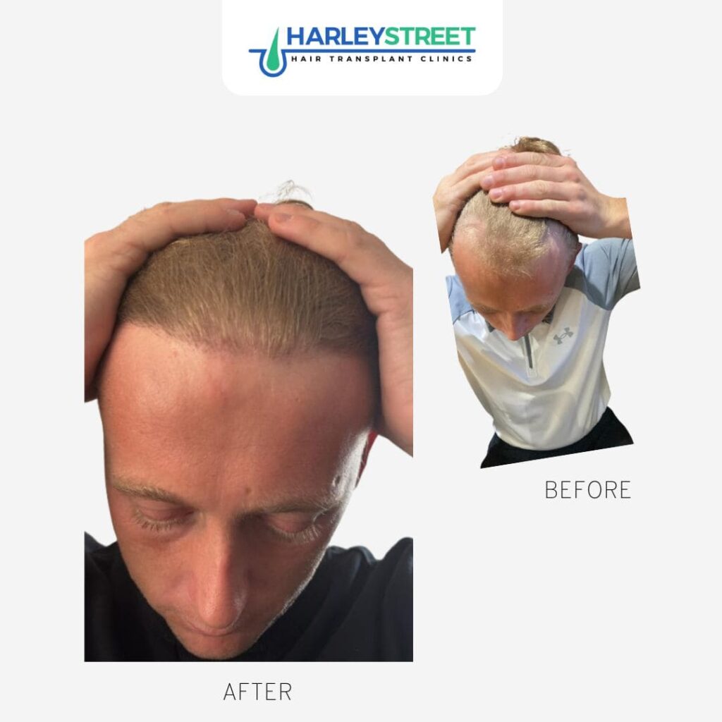 Hair Transplant Glasgow gallery photo