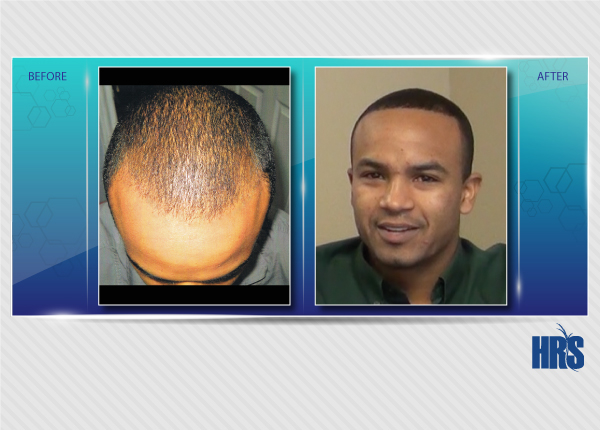 Hair Restoration Specialists gallery photo