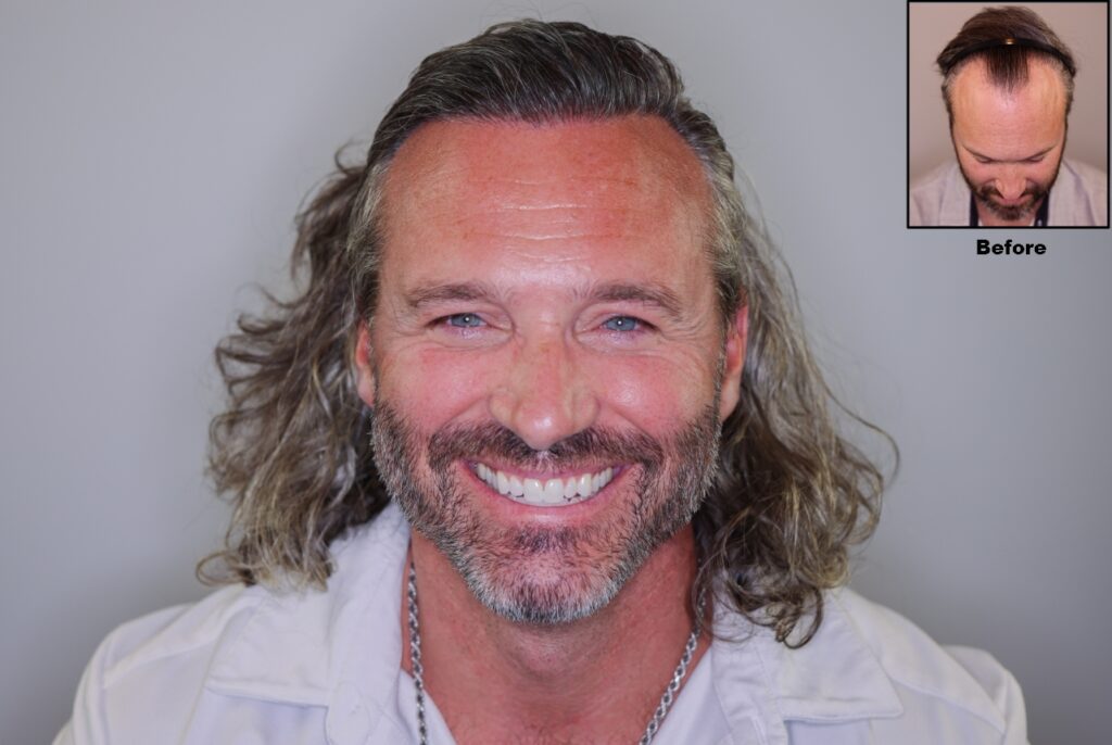 Alvi Armani – Beverly Hills FUE Hair Transplant Clinic gallery photo