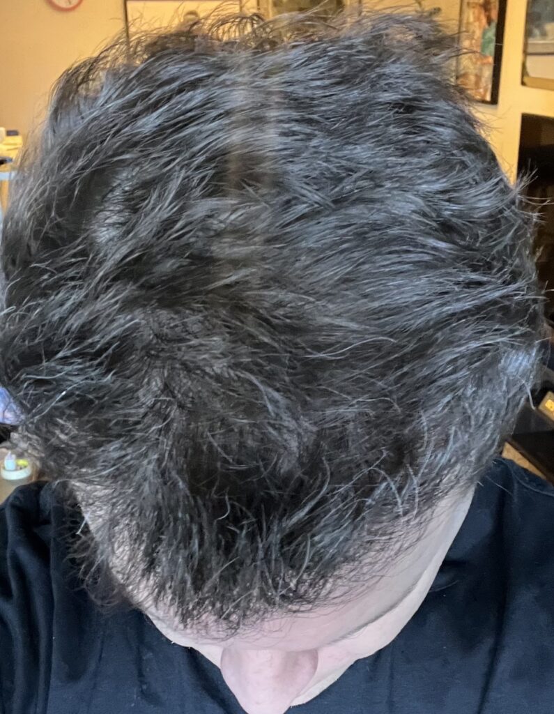 Alvi Armani – Beverly Hills FUE Hair Transplant Clinic gallery photo