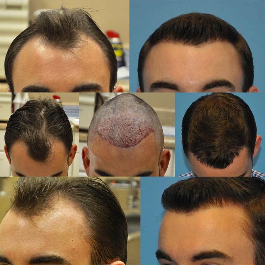 Carolina Hair Surgery: FUE Hair Transplant gallery photo