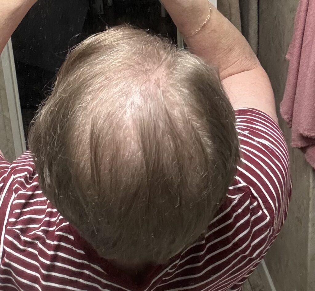 Carolina Hair Surgery: FUE Hair Transplant gallery photo