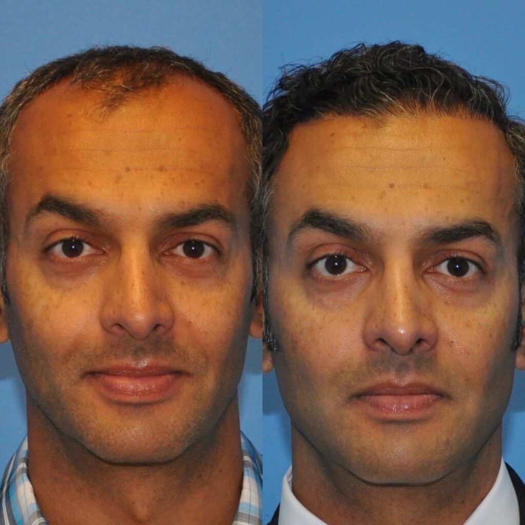 Carolina Hair Surgery: FUE Hair Transplant gallery photo