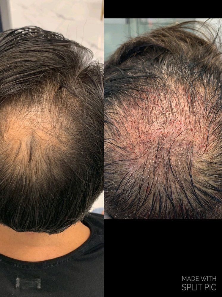 Pure Hair Restoration Center gallery photo
