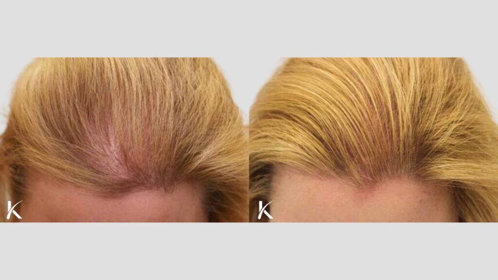 Kopelman Hair Restoration NJ: Hair Transplant Clinic gallery photo