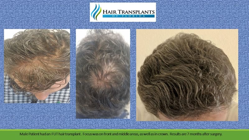 Hair Transplants of Florida gallery photo