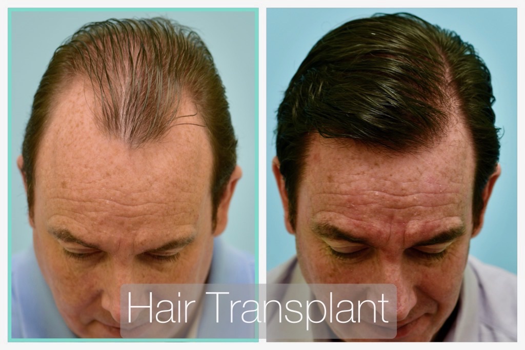 Lam Institute for Hair Restoration – Samuel M. Lam, MD, FACS FISHRS gallery photo