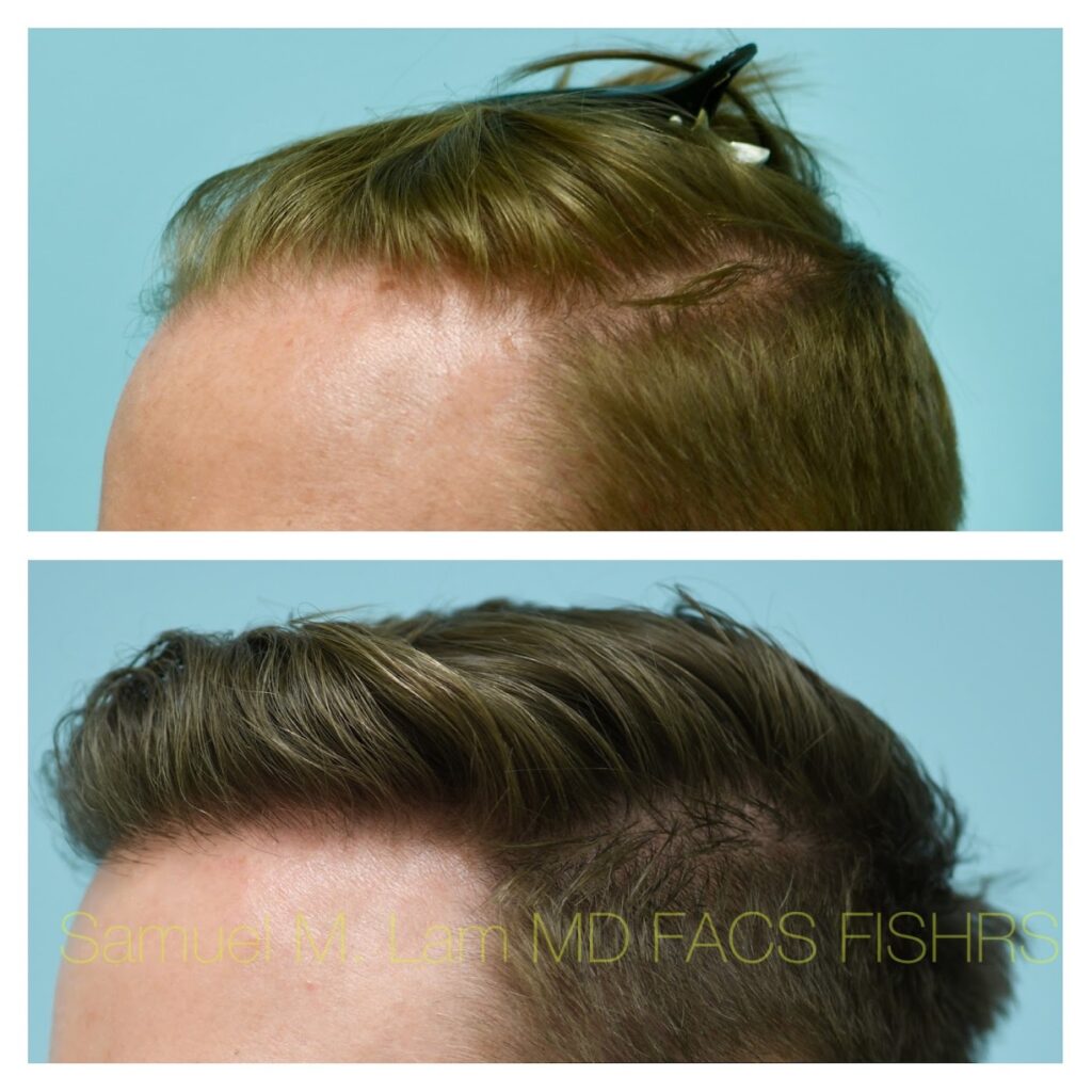 Lam Institute for Hair Restoration – Samuel M. Lam, MD, FACS FISHRS gallery photo