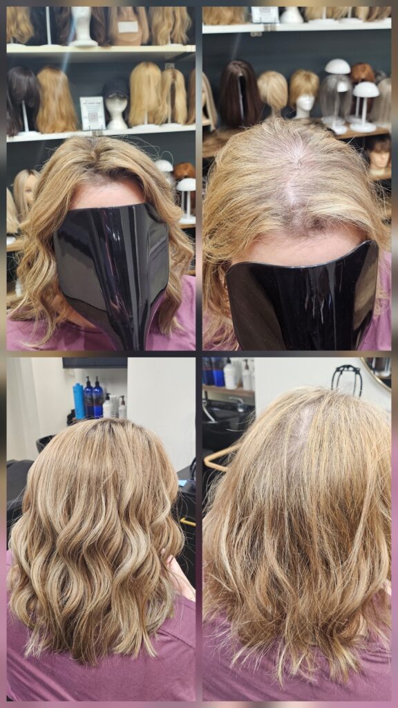 Hair Loss Solutions gallery photo