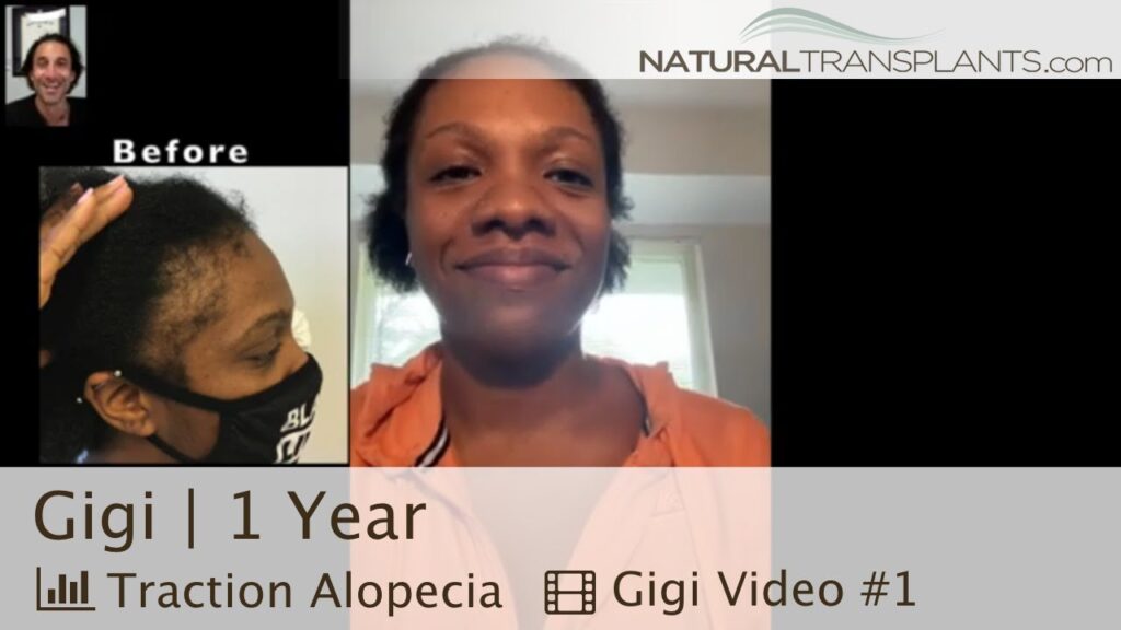 Natural Transplants, Hair Restoration Clinic gallery photo