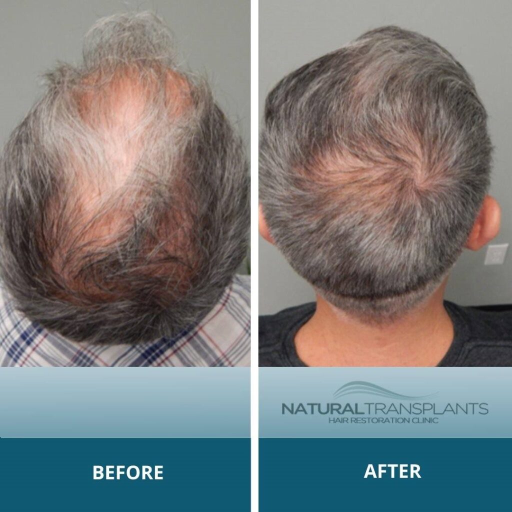 Natural Transplants, Hair Restoration Clinic gallery photo