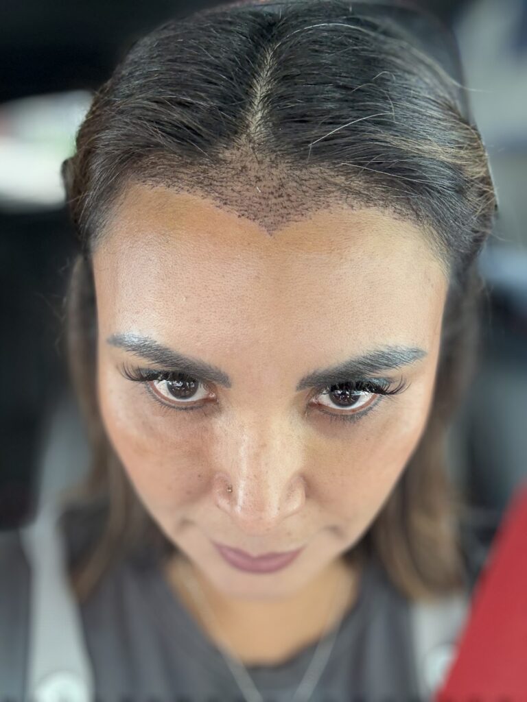 Transplante de cabello hair.c gallery photo