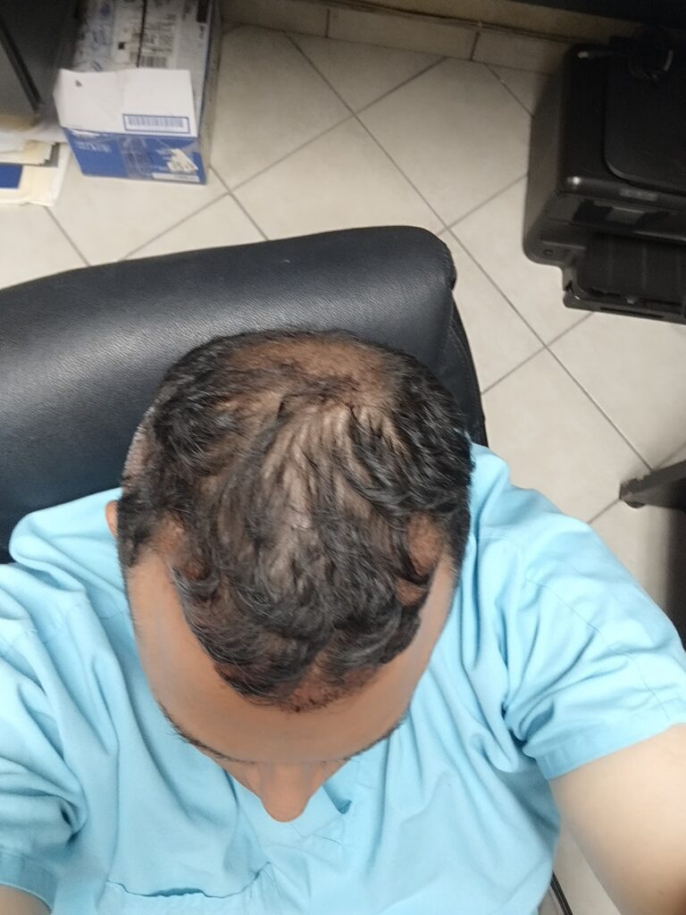 Transplante de cabello hair.c gallery photo