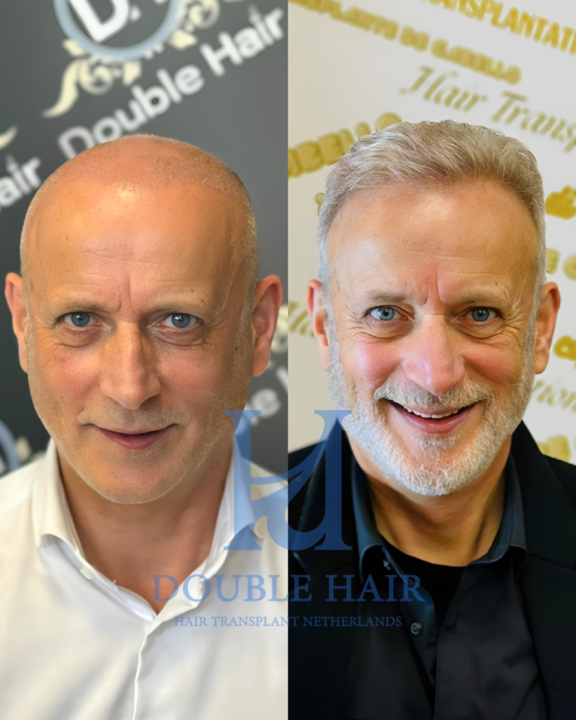 Double Hair Netherlands gallery photo