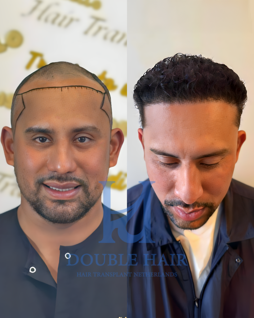 Double Hair Netherlands gallery photo