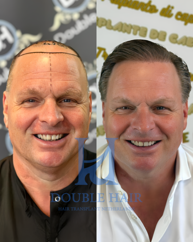 Double Hair Netherlands gallery photo