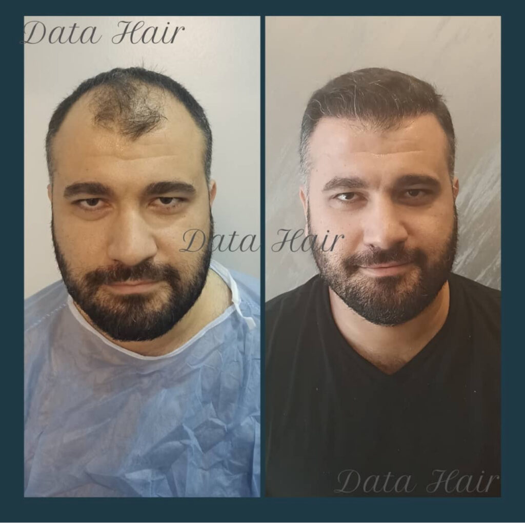 Data Hair Clinic & Eyyüp Tütüncü Saç Ekim Merkezi gallery photo