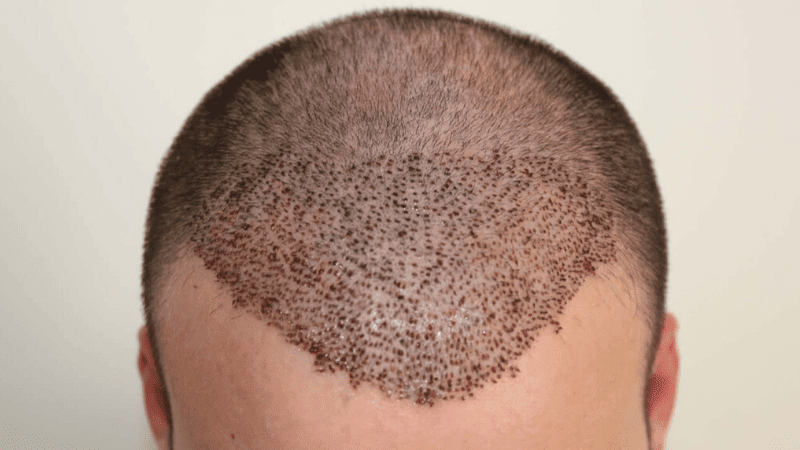 Data Hair Clinic & Eyyüp Tütüncü Saç Ekim Merkezi gallery photo